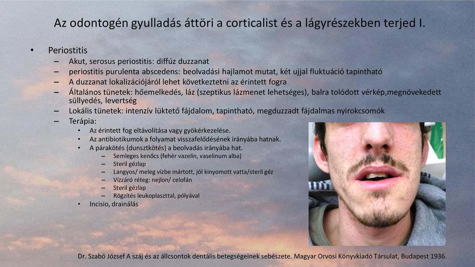 érintett fogra Általános tünetek: hőemelkedés, láz (szeptikus lázmenet lehetséges), balra tolódott vérkép,megnövekedett süllyedés, levertség Lokális tünetek: intenzív lüktető fájdalom, tapintható,