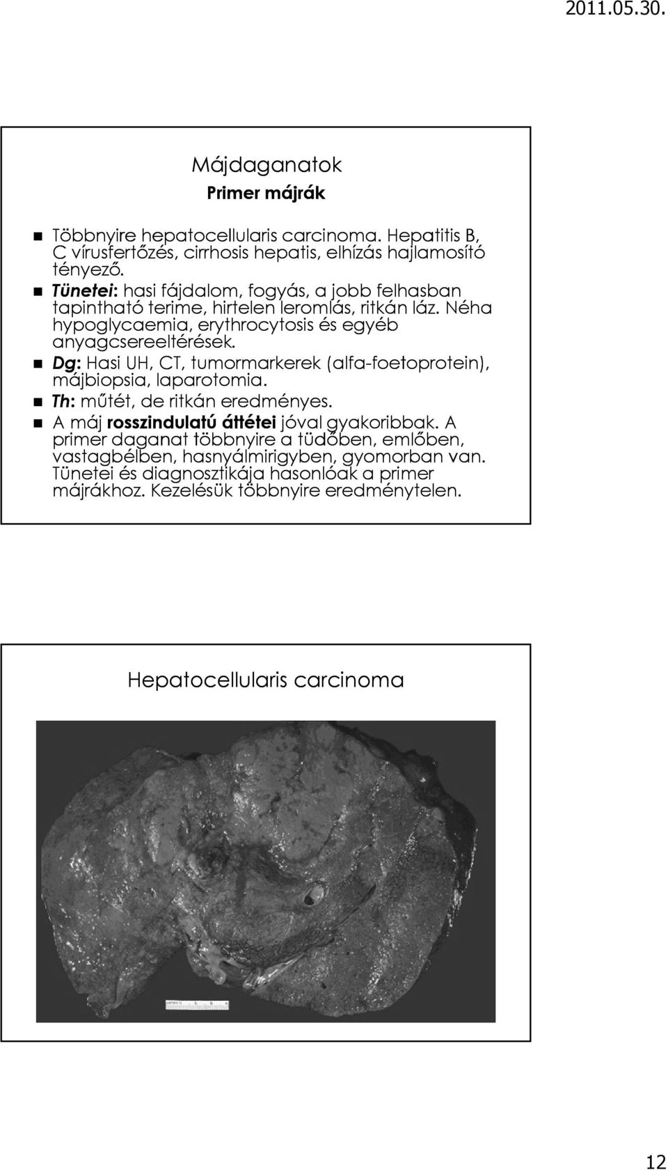 Dg: Hasi UH, CT, tumormarkerek (alfa-foetoprotein), foetoprotein), májbiopsia, laparotomia. Th: műtét, de ritkán eredményes. A máj rosszindulatú áttétei jóval gyakoribbak.