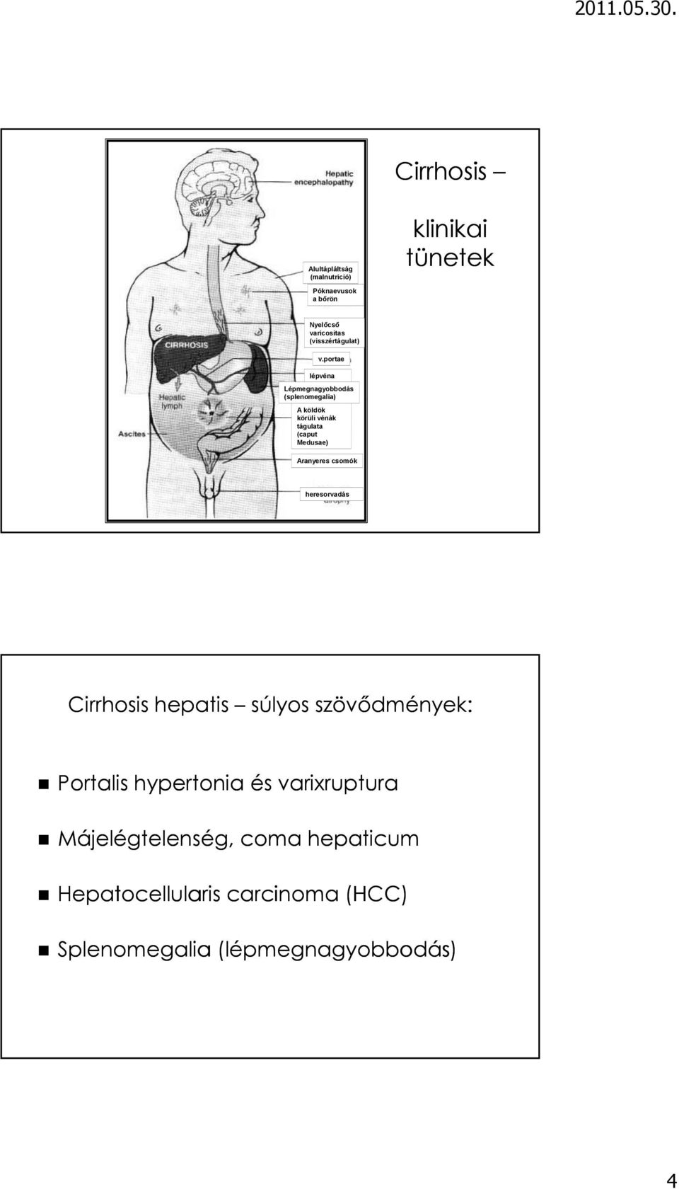 portae lépvéna Lépmegnagyobbodás (splenomegalia) A köldök körüli vénák tágulata (caput Medusae)