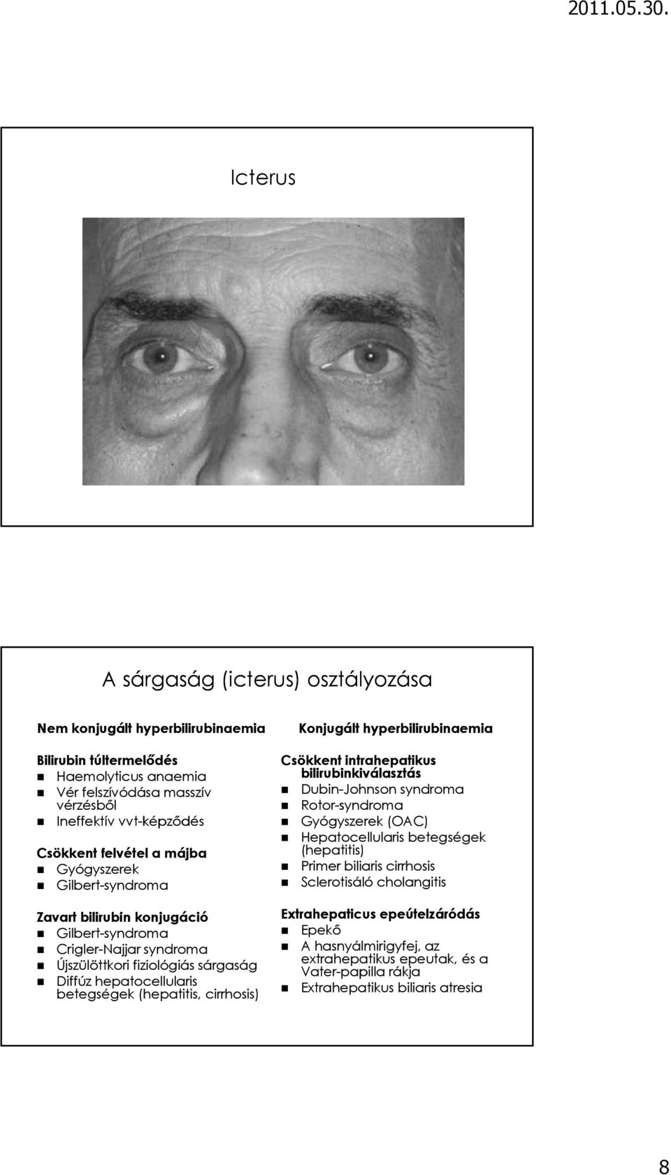 (hepatitis, cirrhosis) Konjugált hyperbilirubinaemia Csökkent intrahepatikus bilirubinkiválasztás Dubin-Johnson syndroma Rotor-syndroma Gyógyszerek (OAC) Hepatocellularis betegségek