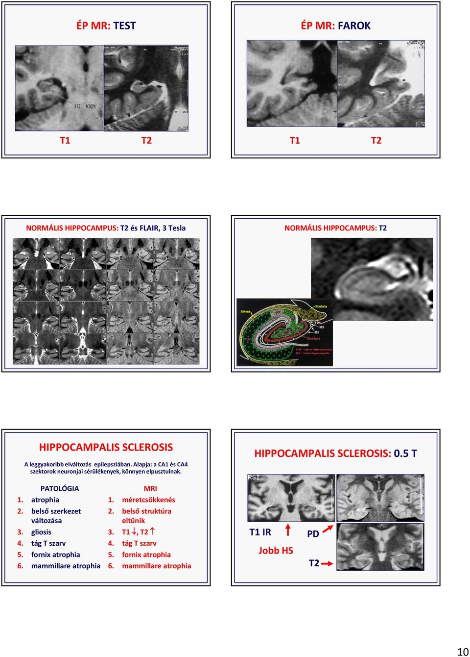 HIPPOCAMPALIS SCLEROSIS: 0.5 T PATOLÓGIA 1. atrophia 2. belső szerkezet változása 3. gliosis 4. tág T szarv 5. fornix atrophia 6.