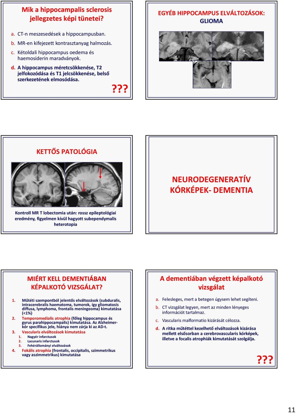 ??? KETTŐS PATOLÓGIA NEURODEGENERATÍV KÓRKÉPEK DEMENTIA Kontroll MR T lobectomia után: rossz epileptológiai eredmény, figyelmen kívül hagyott subependymalis heterotopia MIÉRT KELL DEMENTIÁBAN