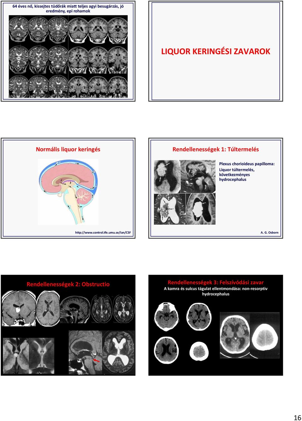 következményes hydrocephalus http://www.control.tfe.umu.se/ian/csf A. G.