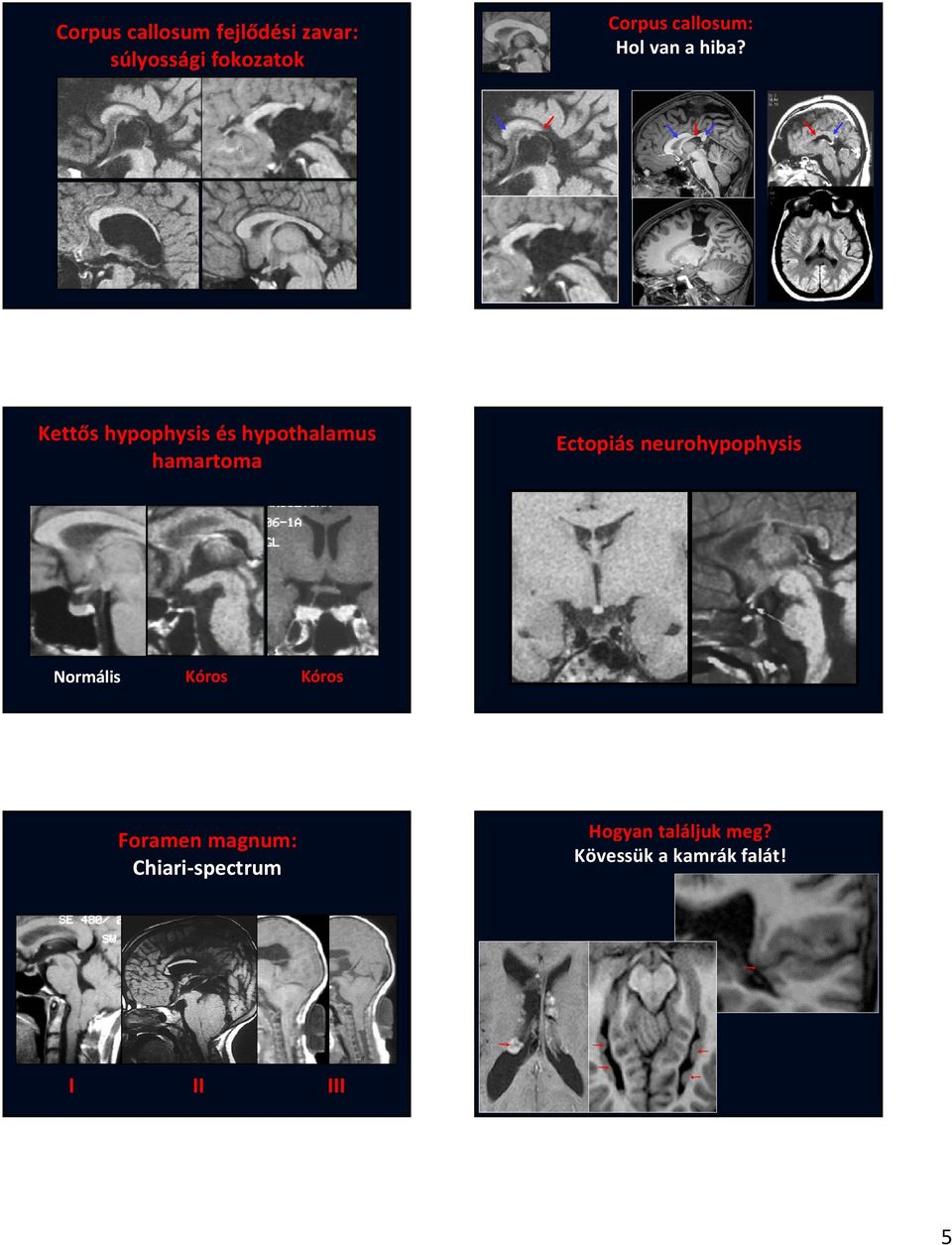 Kettős hypophysis és hypothalamus hamartoma Ectopiás