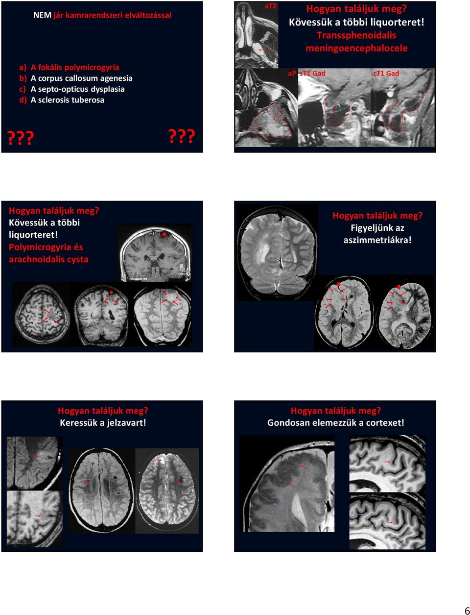 c) A septo-opticus dysplasia d) A sclerosis tuberosa ap st1 Gad ct1 Gad Kövessük a többi