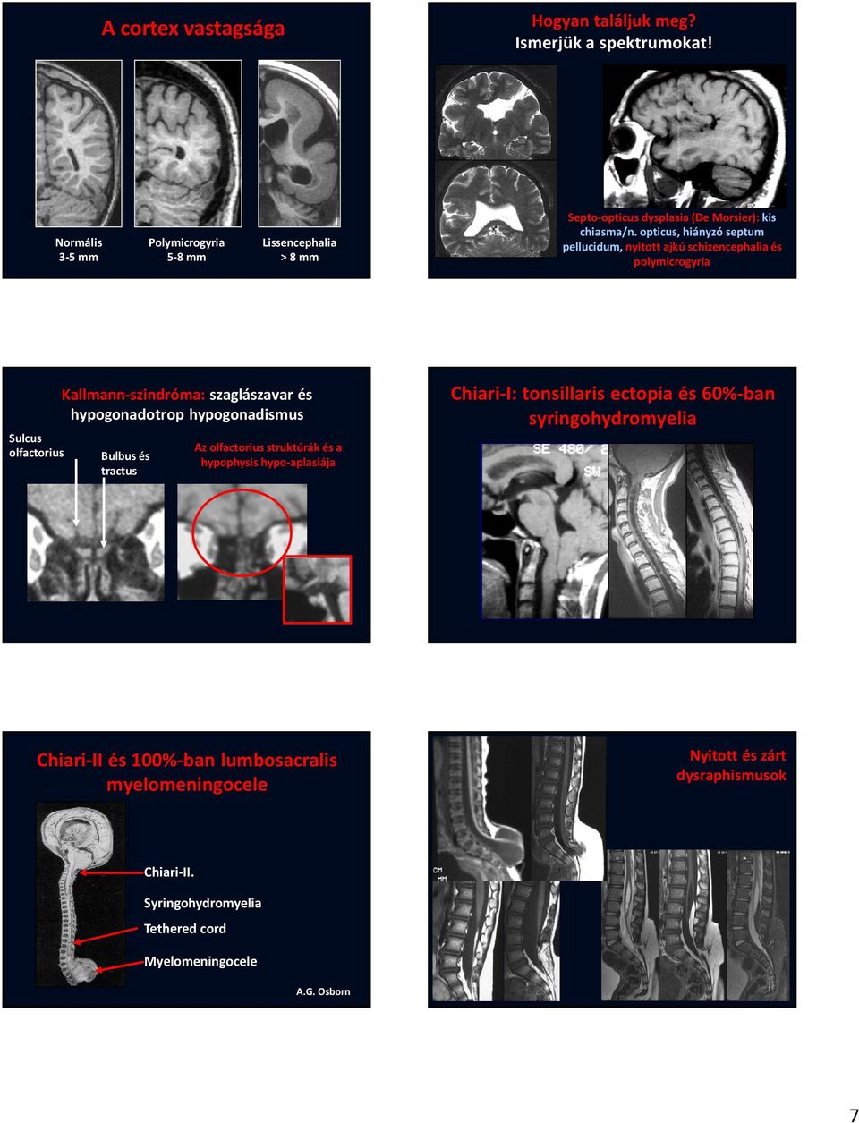 olfactorius Bulbus és tractus Septo-opticus dysplasia (De Morsier): kis chiasma/n.