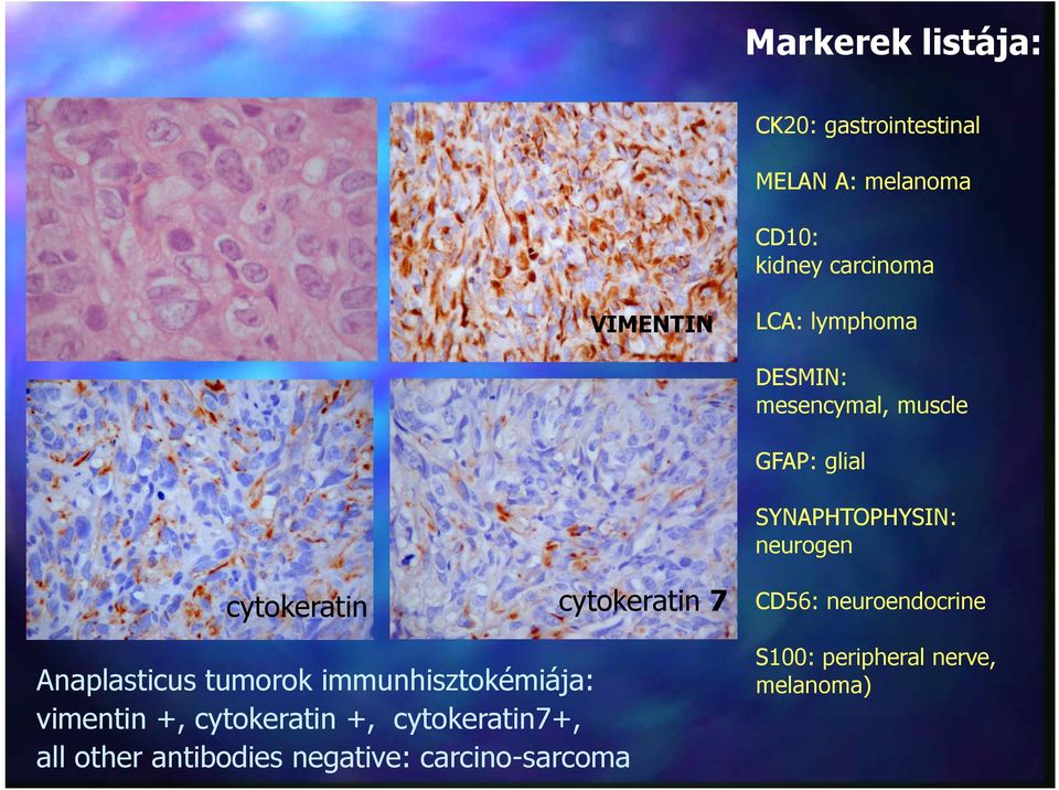 cytokeratin 7 Anaplasticus tumorok immunhisztokémiája: vimentin +, cytokeratin +,