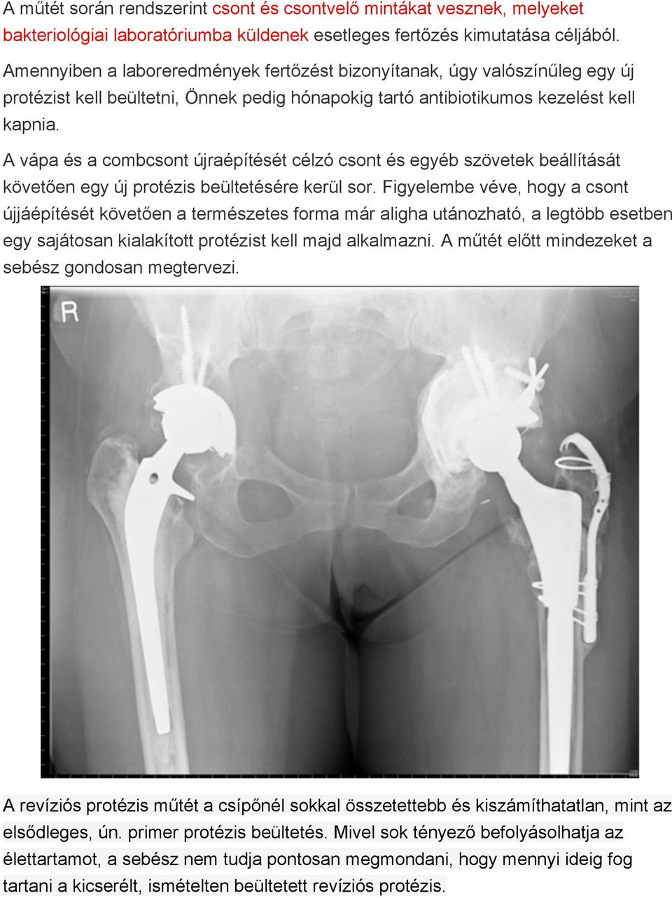 A vápa és a combcsont újraépítését célzó csont és egyéb szövetek beállítását követően egy új protézis beültetésére kerül sor.