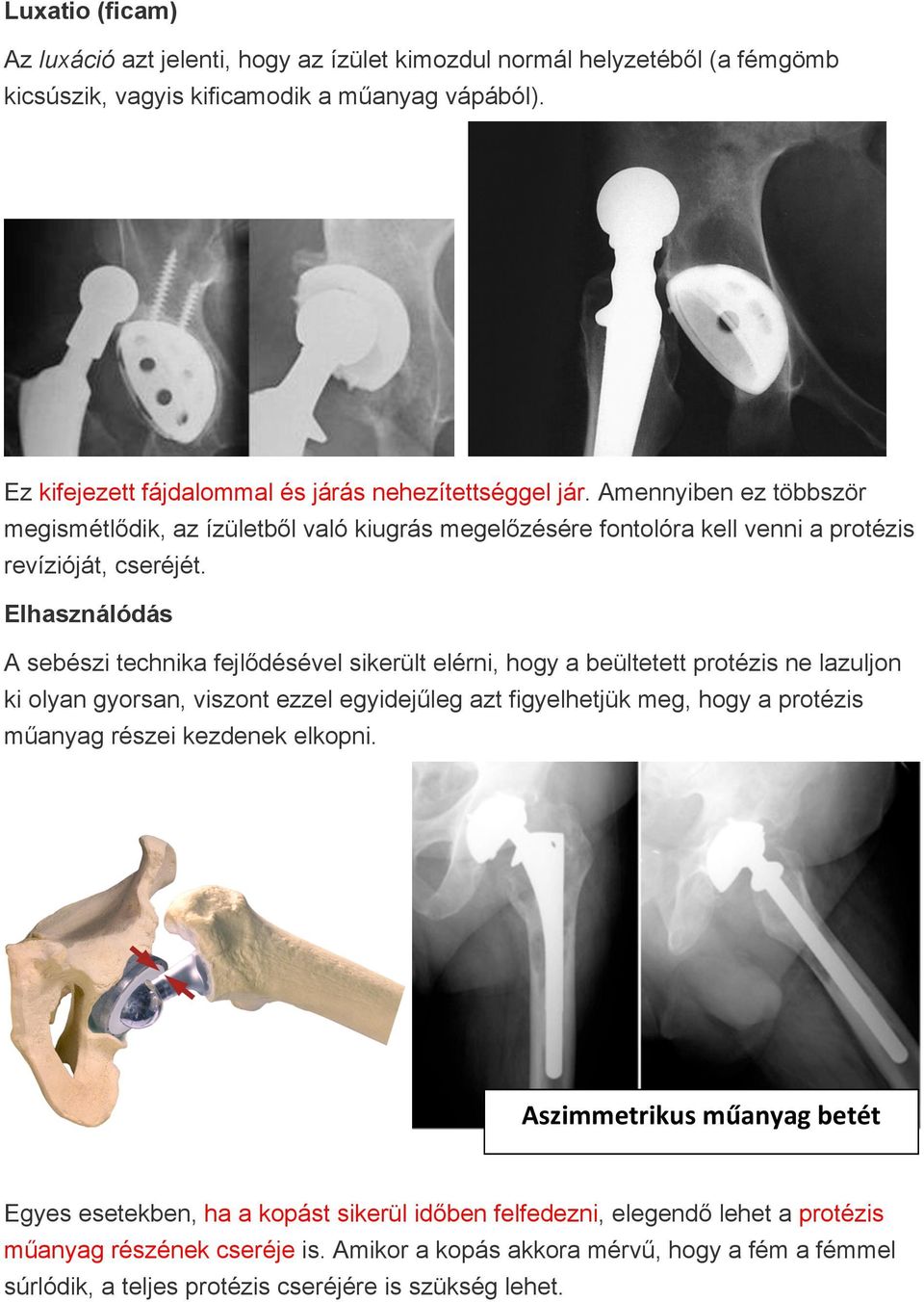 Elhasználódás A sebészi technika fejlődésével sikerült elérni, hogy a beültetett protézis ne lazuljon ki olyan gyorsan, viszont ezzel egyidejűleg azt figyelhetjük meg, hogy a protézis műanyag