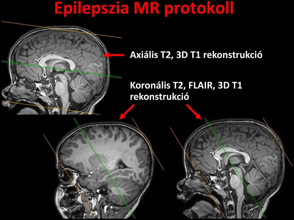 rekonstrukció Koronális