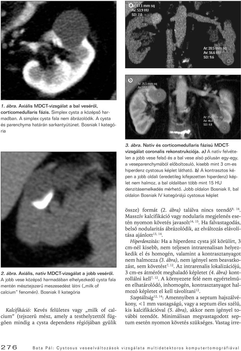 a) A natív felvételen a jobb vese felsô és a bal vese alsó pólusán egy-egy, a veseparenchymából elôboltosuló, kisebb mint 3 cm-es hiperdenz cystosus képlet látható.