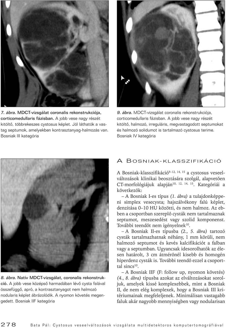 A jobb vese nagy részét kitöltô, halmozó, irreguláris, megvastagodott septumokat és halmozó solidumot is tartalmazó cystosus terime. Bosniak IV kategória A BOSNIAK-KLASSZIFIKÁCIÓ 8. ábra.