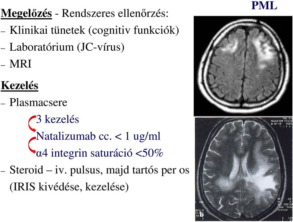 3 kezelés Natalizumab cc.