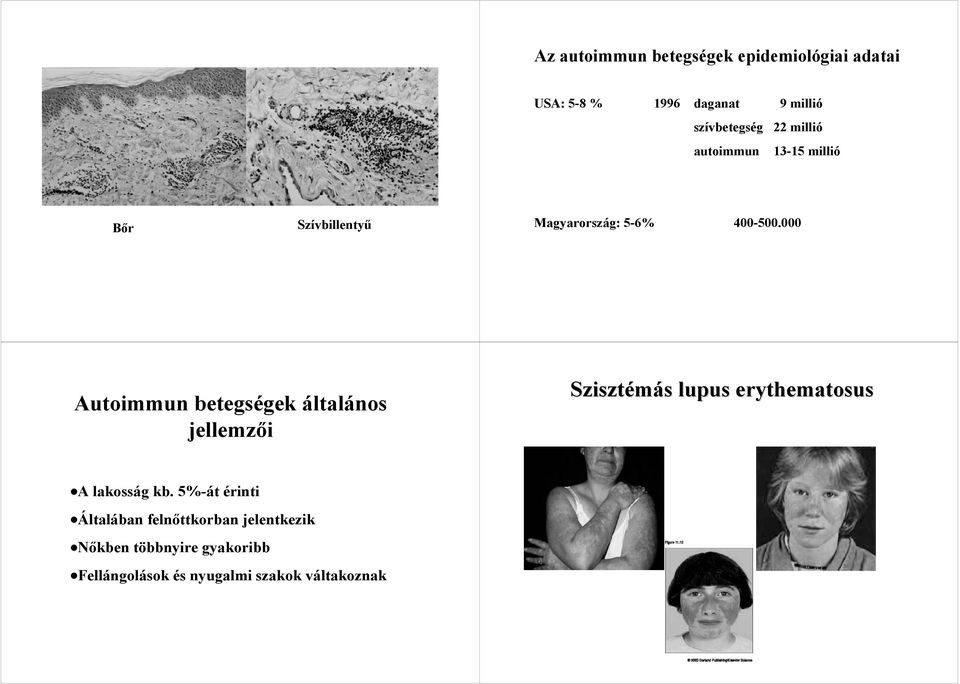 000 Autoimmun betegségek általános jellemzői Szisztémás s lupus erythematosus A lakosság kb.