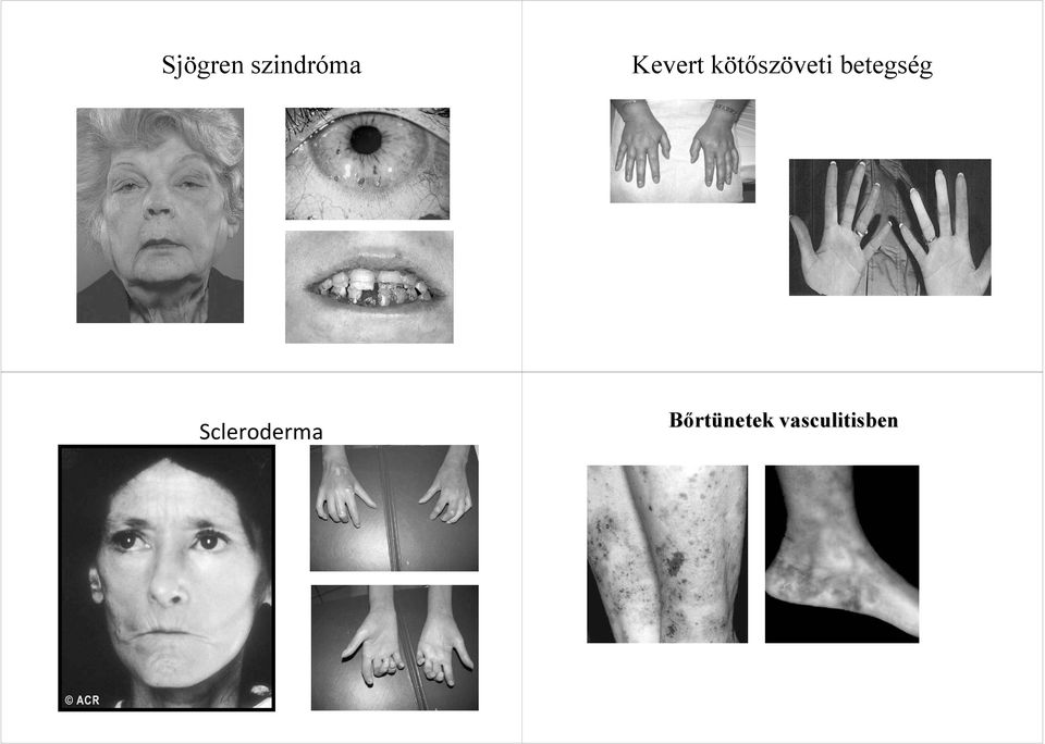 betegség Scleroderma