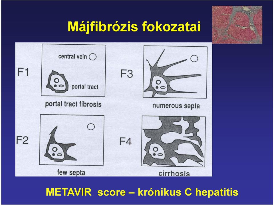 METAVIR score