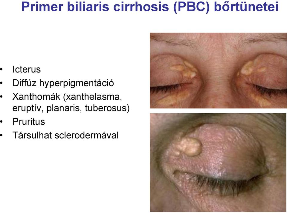 hyperpigmentáció Xanthomák (xanthelasma,