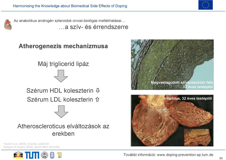 Megvastagodott szívkoszorúér fala 32 éves testépítő Infarktus, 32 éves testépítő Atheroscleroticus