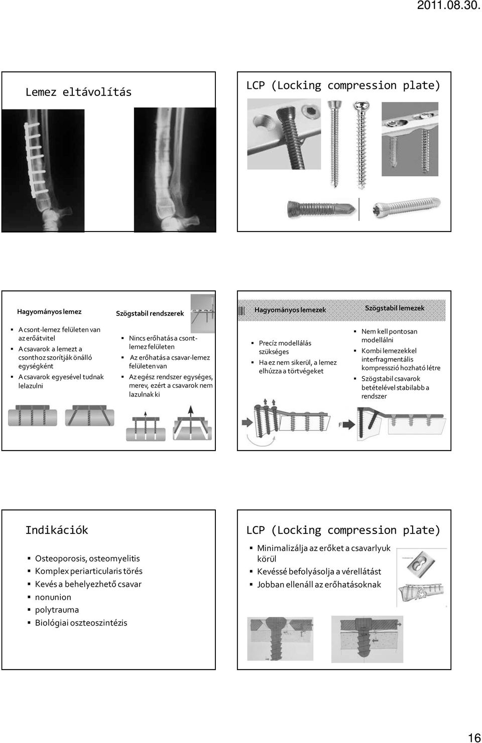 csavarok nem lazulnak ki Precíz modellálás szükséges Ha ez nem sikerül, a lemez elhúzza a törtvégeket Nem kell pontosan modellálni Kombi lemezekkel interfragmentális kompresszió hozható létre