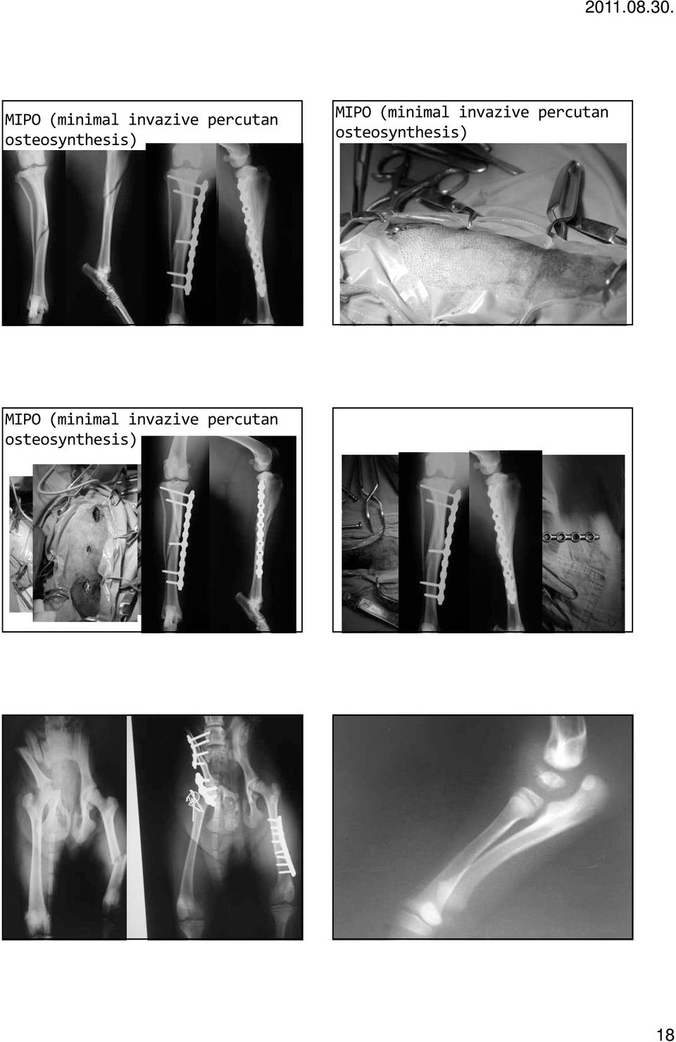 osteosynthesis) 18