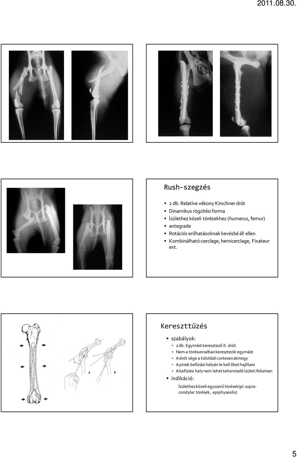 kevésbé áll ellen Kombinálható:cerclage, hemicerclage, Fixateur ext. Kereszttűzés szabályok: 2 db. Egymást keresztező K.