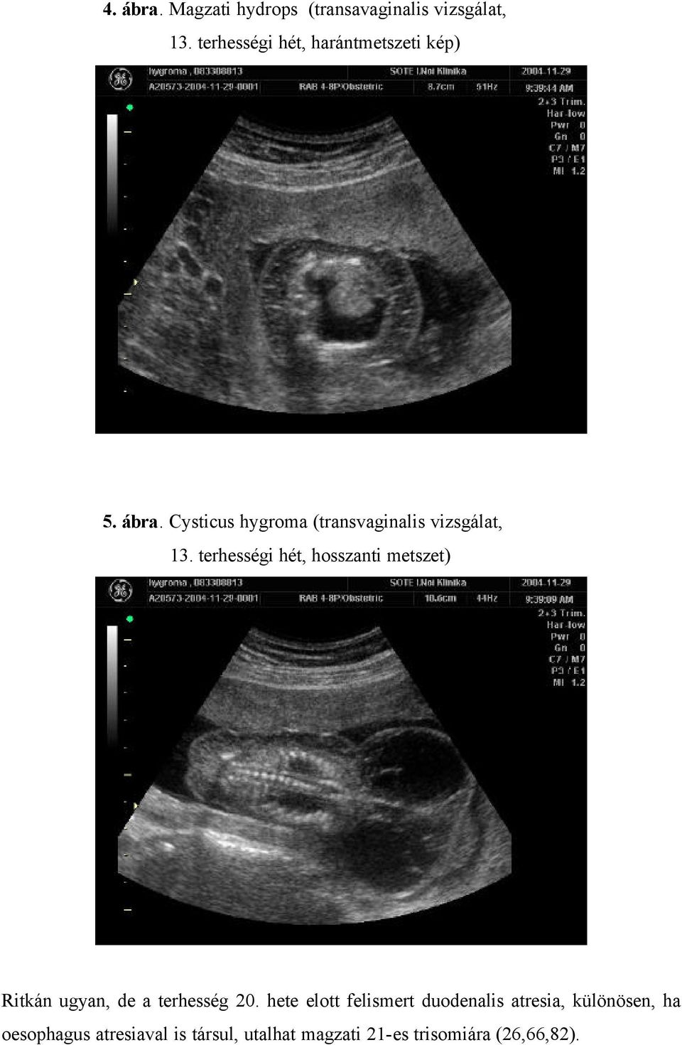 Cysticus hygroma (transvaginalis vizsgálat, 13.