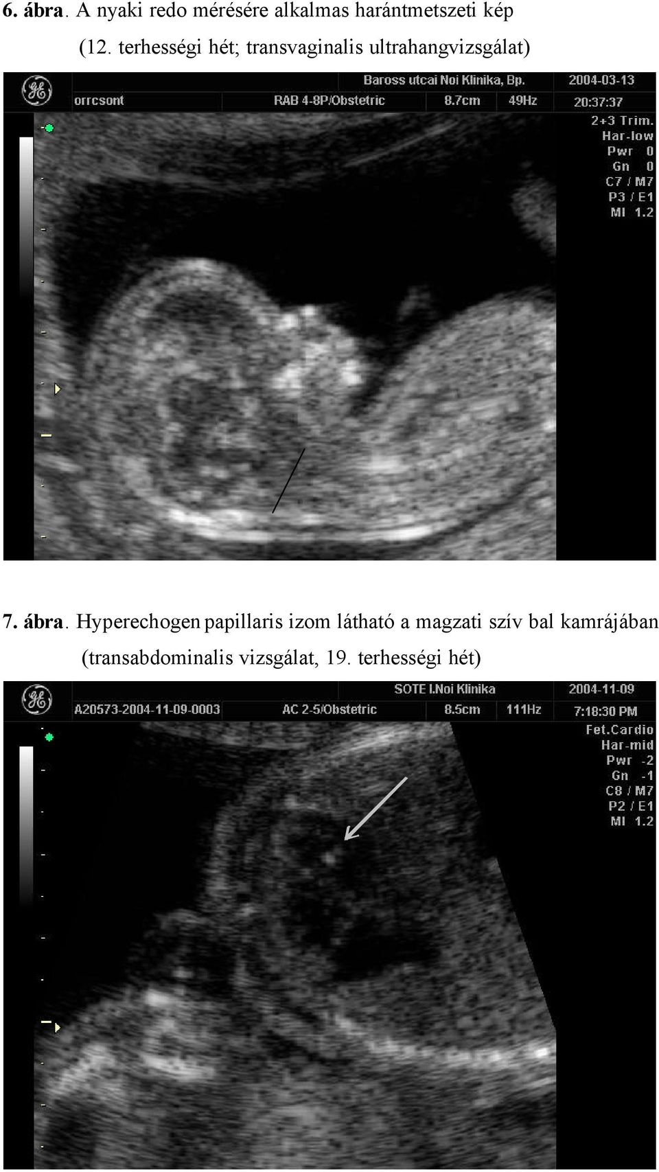 terhességi hét; transvaginalis ultrahangvizsgálat) 7. ábra.