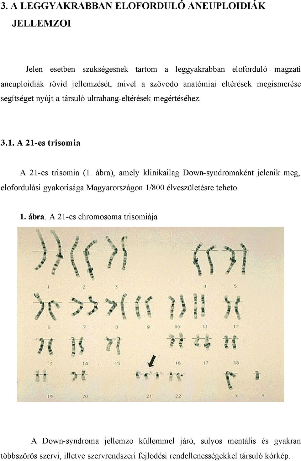 ábra), amely klinikailag Down-syndromaként jelenik meg, elofordulási gyakorisága Magyarországon 1/800 élveszületésre teheto. 1. ábra.