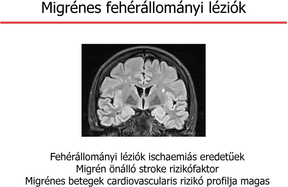 eredetűek Migrén önálló stroke