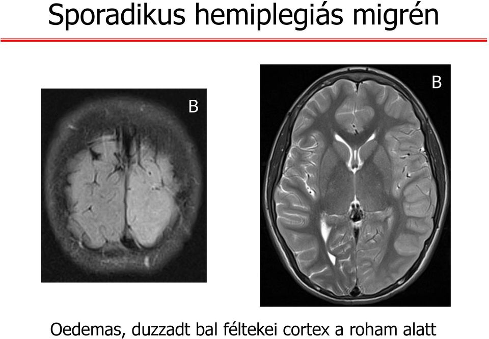 B Oedemas, duzzadt