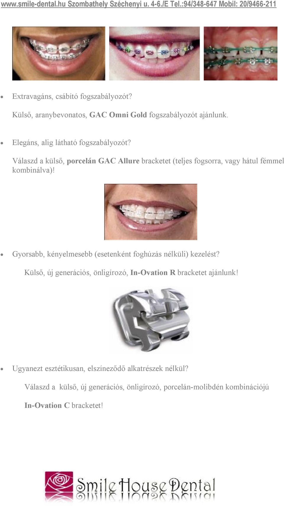 Válaszd a külső, porcelán GAC Allure bracketet (teljes fogsorra, vagy hátul fémmel kombinálva)!