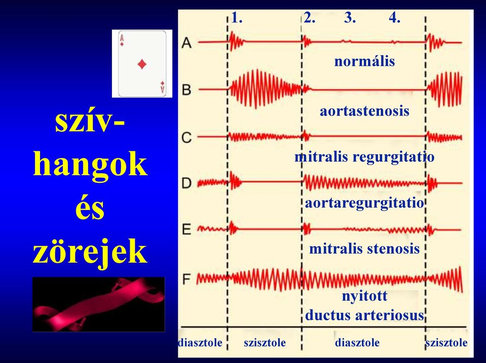 mitralis regurgitatio aortaregurgitatio