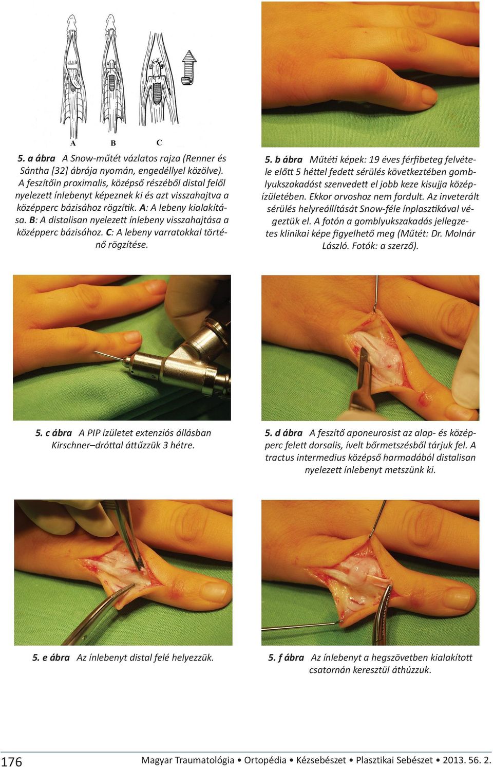 B: A distalisan nyelezett ínlebeny visszahajtása a középperc bázisához. C: A lebeny varratokkal történő rögzítése. 5.
