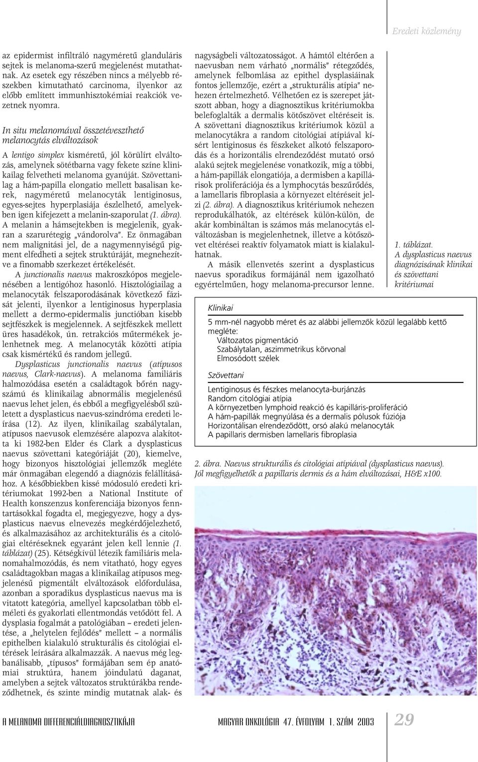 In situ melanomával összetéveszthetô melanocytás elváltozások A lentigo simplex kisméretû, jól körülírt elváltozás, amelynek sötétbarna vagy fekete színe klinikailag felvetheti melanoma gyanúját.