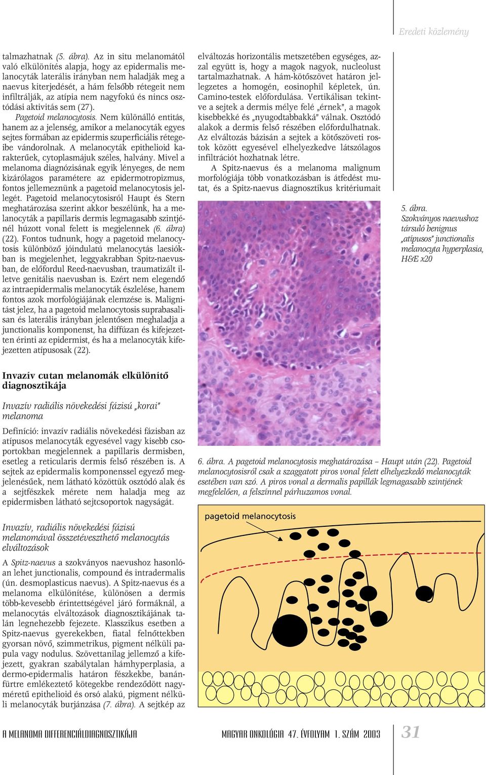 nagyfokú és nincs osztódási aktivitás sem (27). Pagetoid melanocytosis.