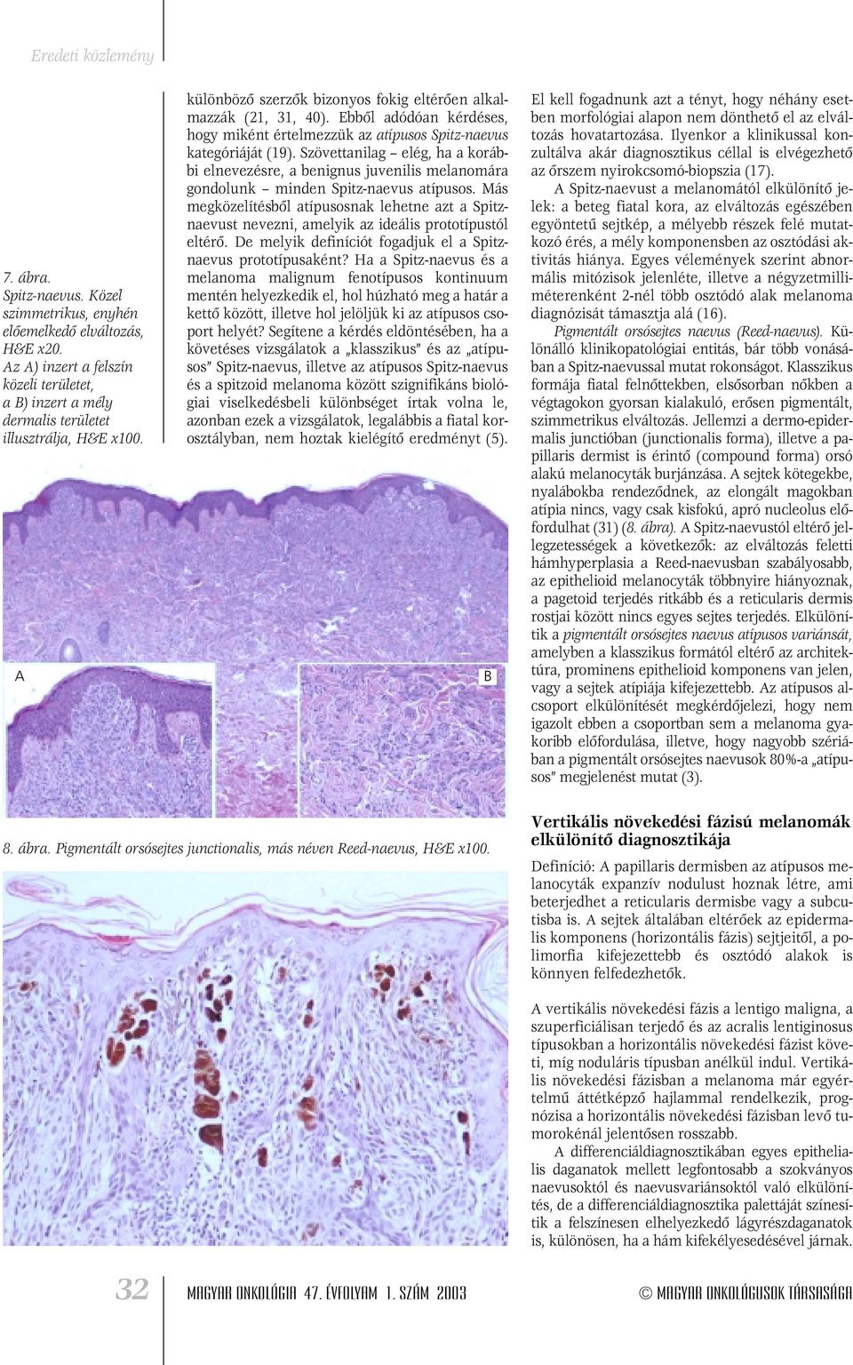 Ebbôl adódóan kérdéses, hogy miként értelmezzük az atípusos Spitz-naevus kategóriáját (19).