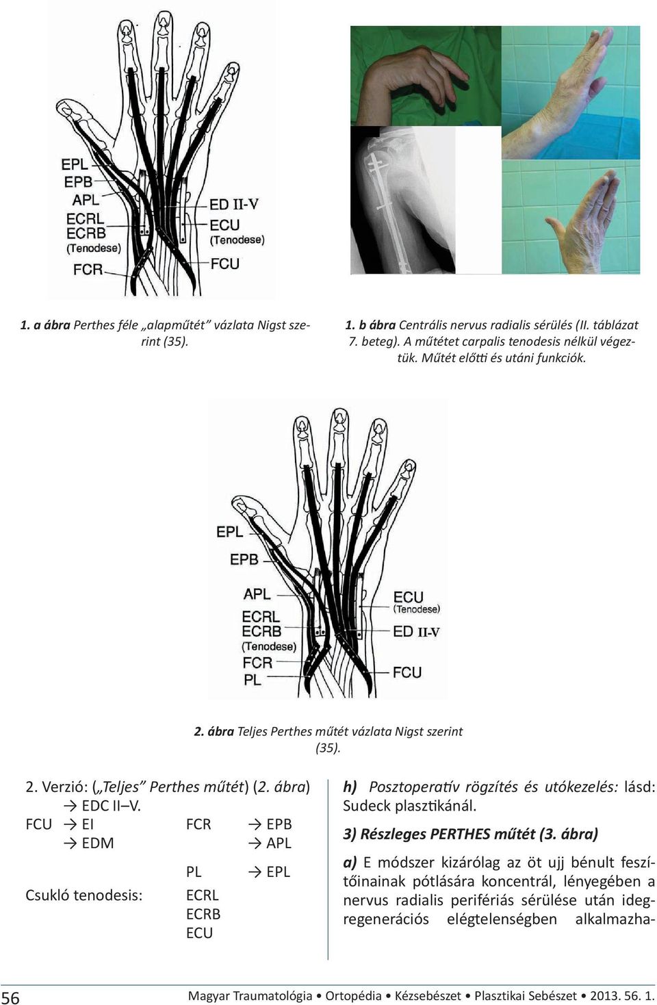FCR EPB PL Csukló tenodesis: ECRL ECRB ECU h) Posztopera v rögzítés és utókezelés: lásd: Sudeck plasz kánál. 3) Részleges PERTHES (3.