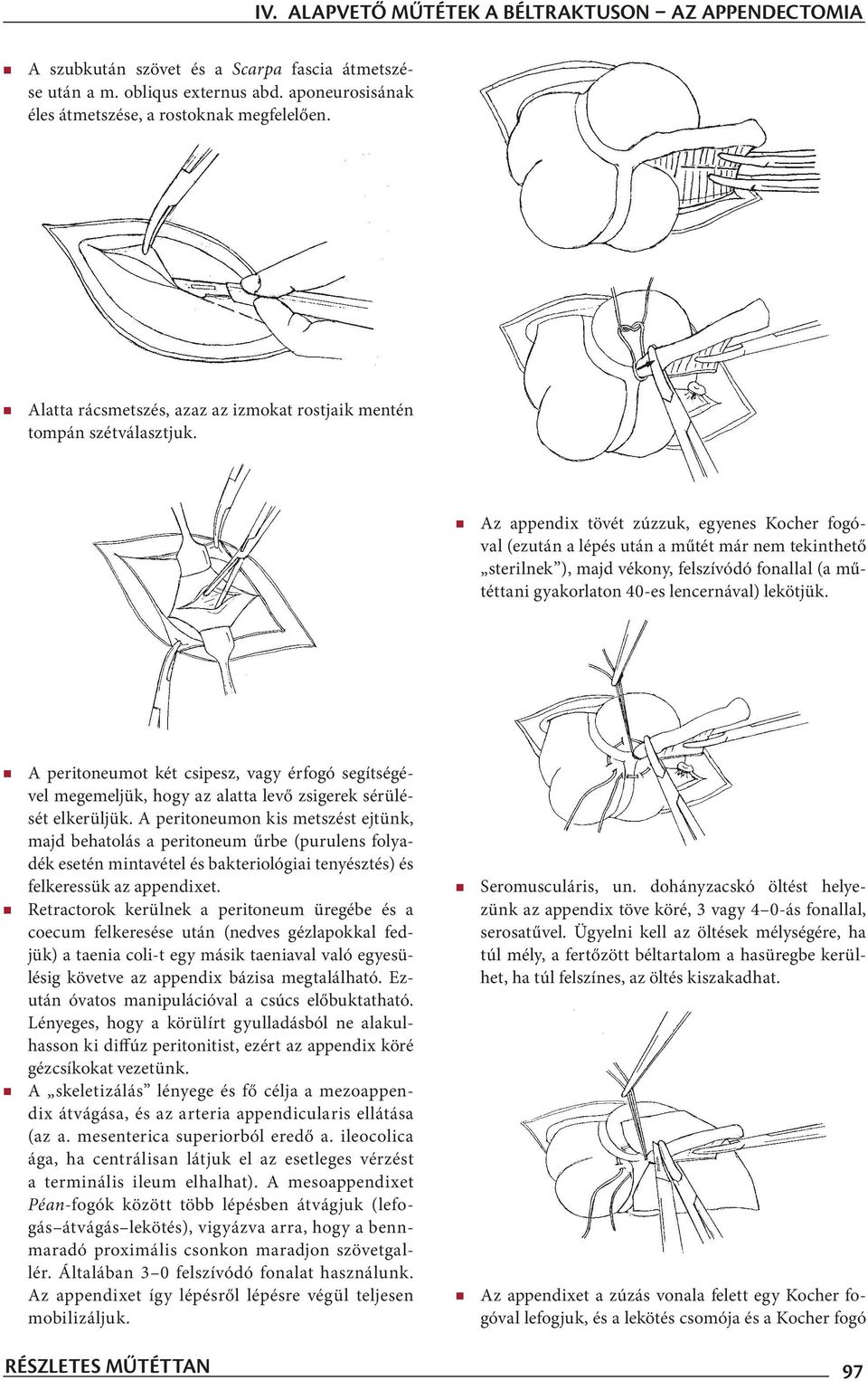 Az appendix tövét zúzzuk, egyenes Kocher fogóval (ezután a lépés után a műtét már nem tekinthető sterilnek ), majd vékony, felszívódó fonallal (a műtéttani gyakorlaton 40-es lencernával) lekötjük.