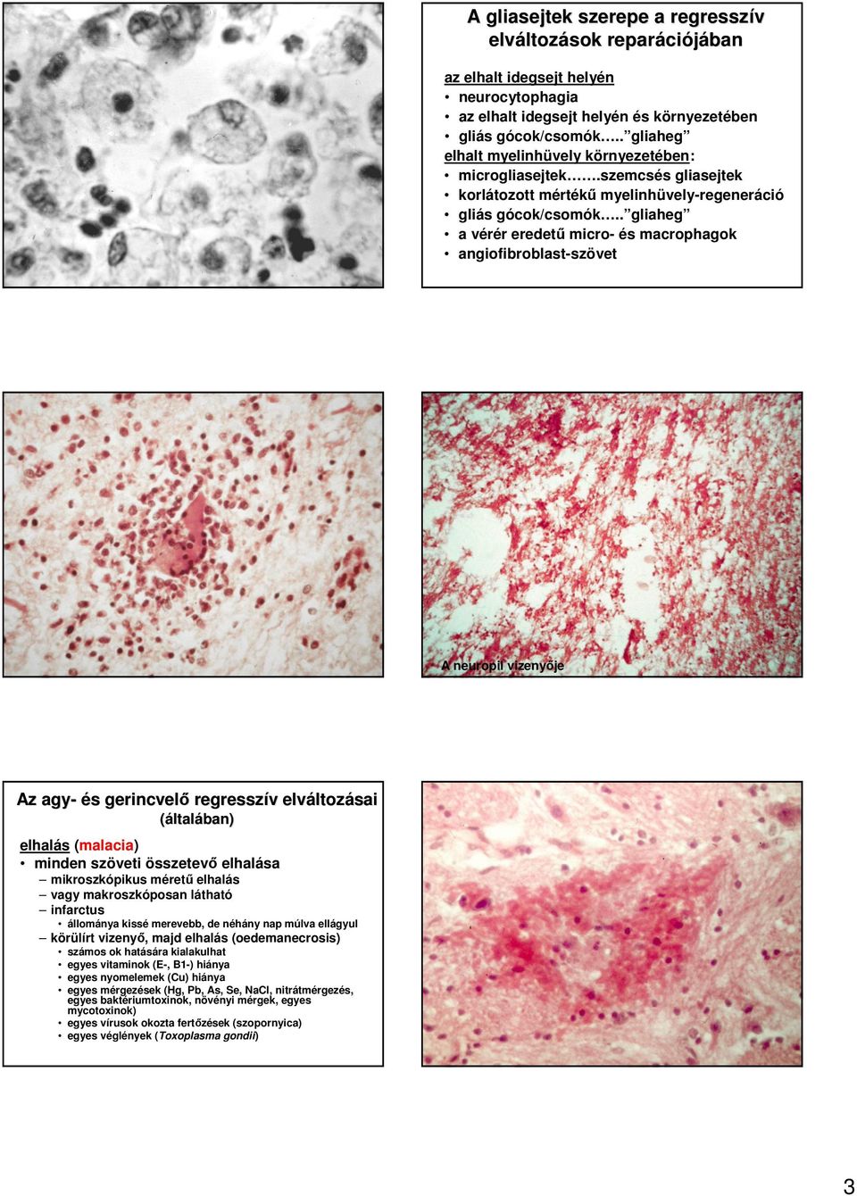 . gliaheg a vérér eredető micro- és macrophagok angiofibroblast-szövet A neuropil vizenyıje Az agy- és s gerincvelı regresszív v elhalás (malacia) minden szöveti összetevı elhalása mikroszkópikus