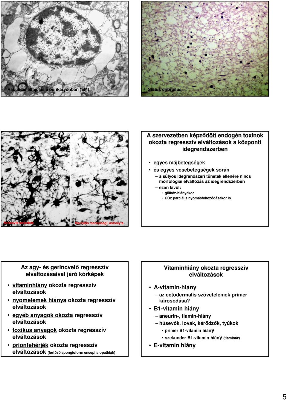 astrocyta Az agy- és s gerincvelı regresszív val járój kórképek vitaminhiány okozta regresszív elvá nyomelemek hiánya okozta regresszív elvá egyéb anyagok okozta regresszív elvá toxikus anyagok