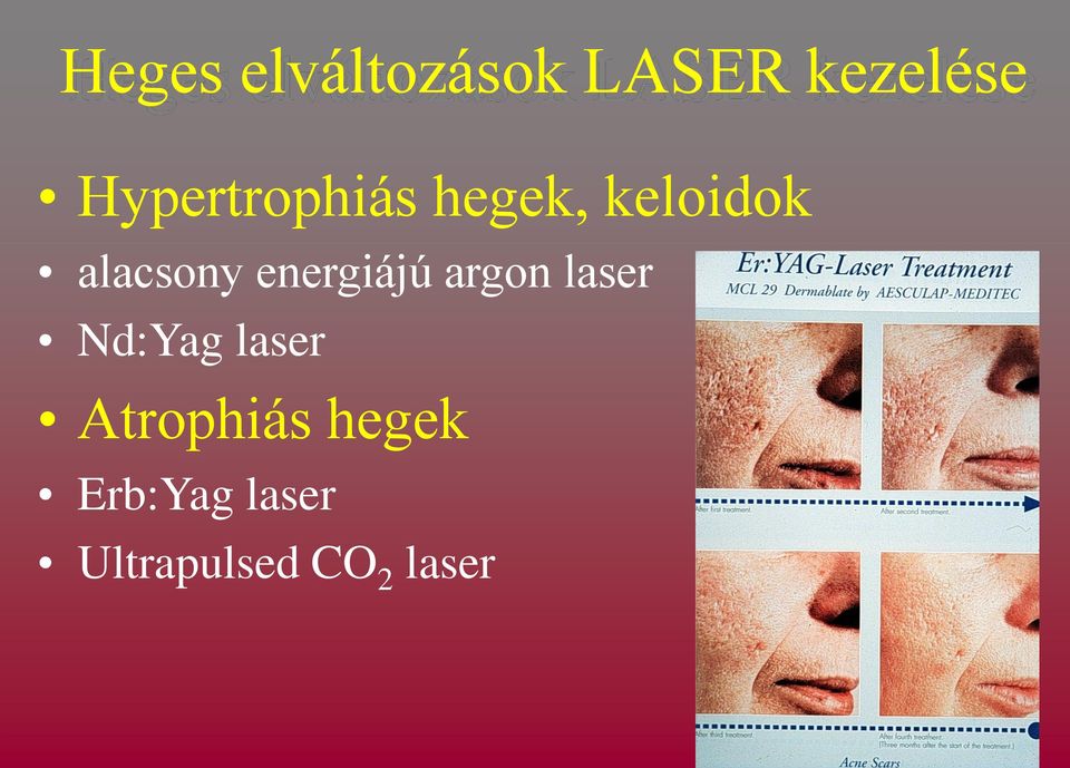 energiájú argon laser Nd:Yag laser