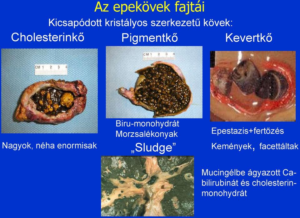 Biru-monohydrát Morzsalékonyak Sludge Epestazis+fertőzés