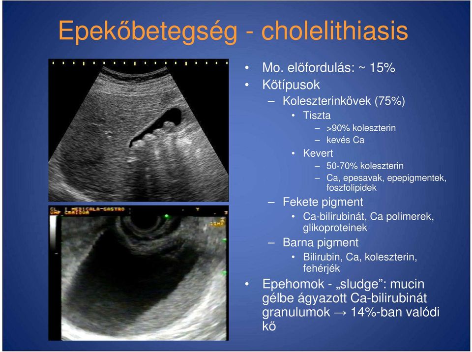 50-70% koleszterin Ca, epesavak, epepigmentek, foszfolipidek Fekete pigment Ca-bilirubinát, Ca