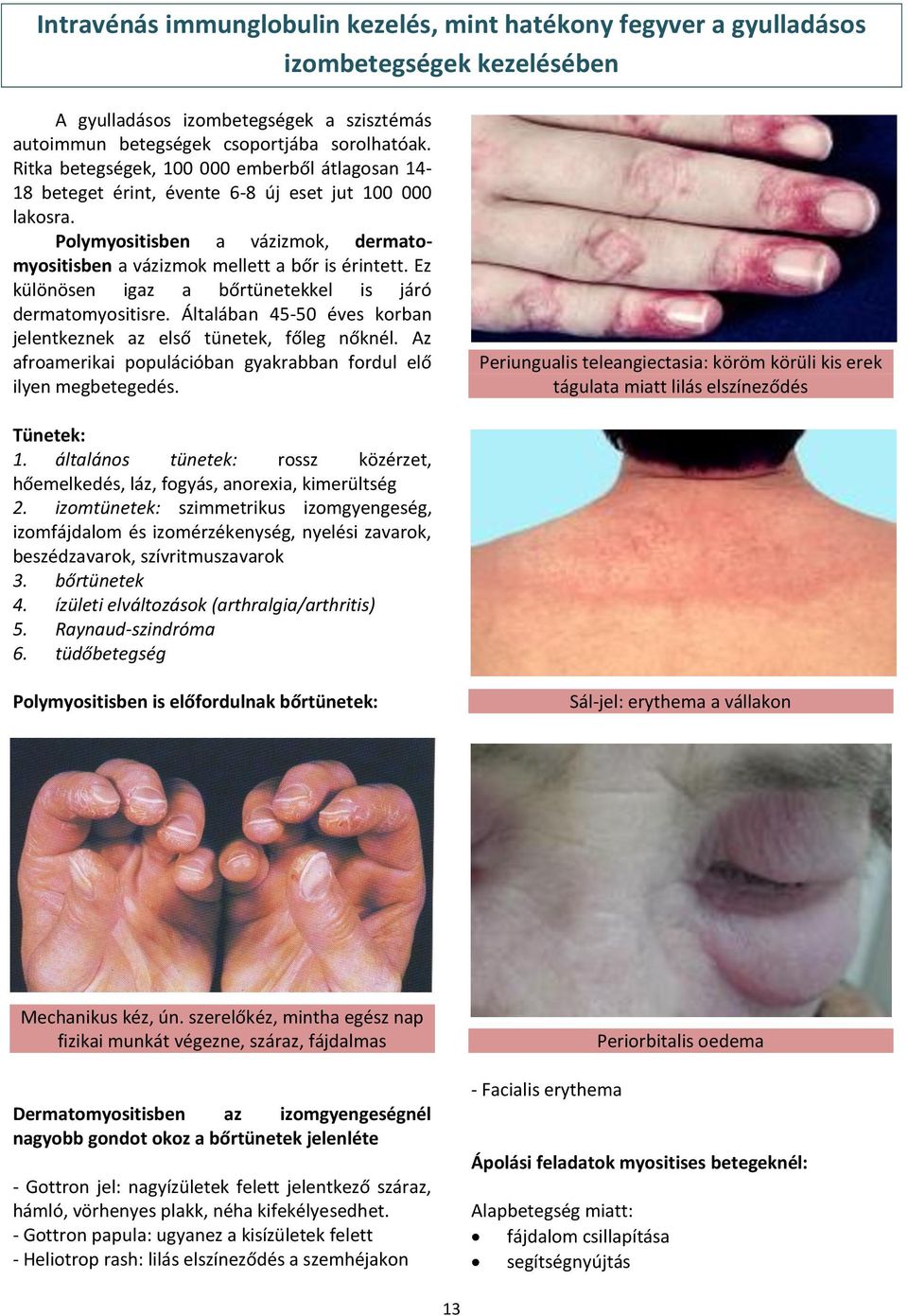 Ez különösen igaz a bőrtünetekkel is járó dermatomyositisre. Általában 45-50 éves korban jelentkeznek az első tünetek, főleg nőknél.