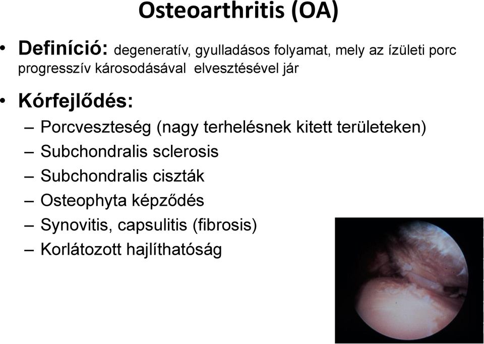 Porcveszteség (nagy terhelésnek kitett területeken) Subchondralis sclerosis