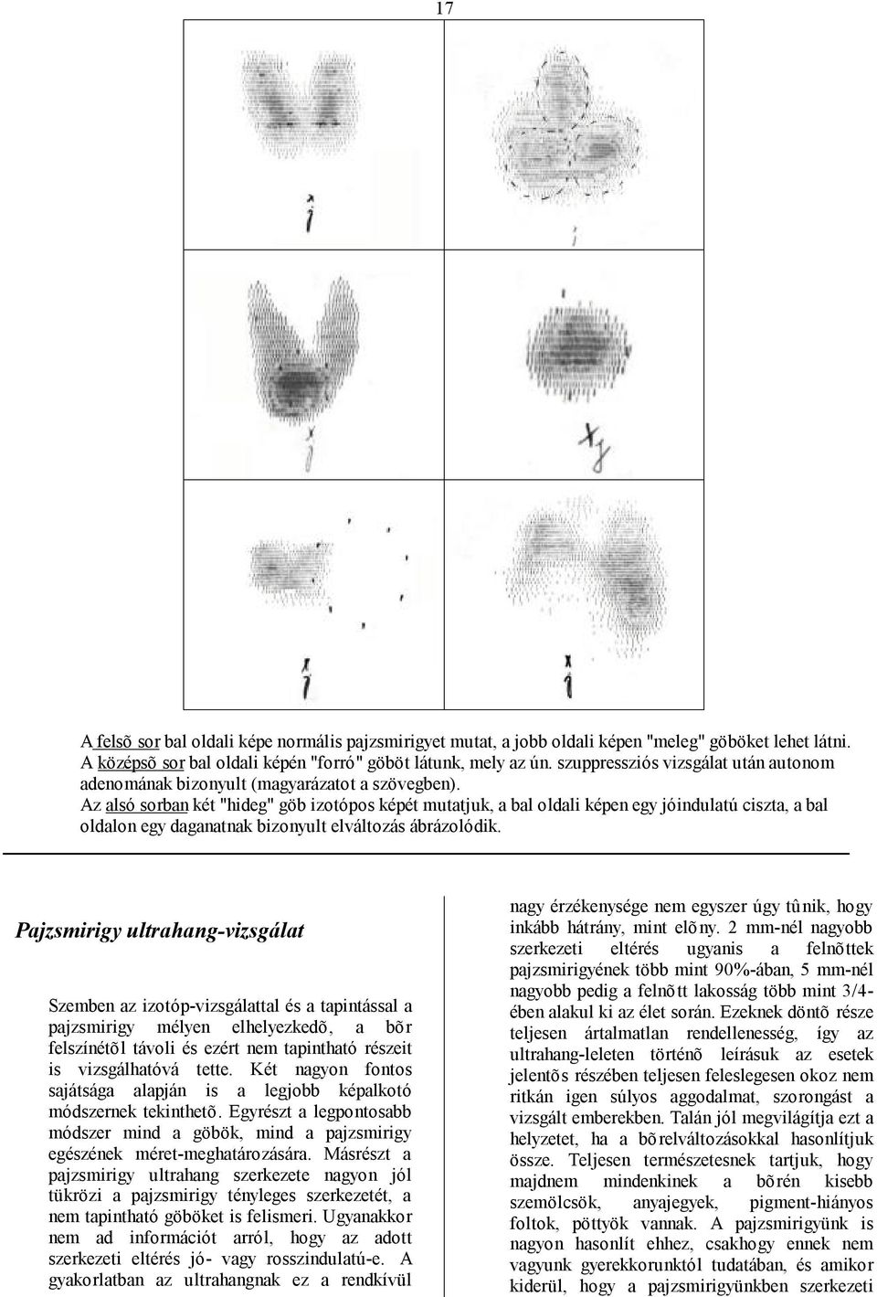 Az alsó sorban két "hideg" göb izotópos képét mutatjuk, a bal oldali képen egy jóindulatú ciszta, a bal oldalon egy daganatnak bizonyult elváltozás ábrázolódik.