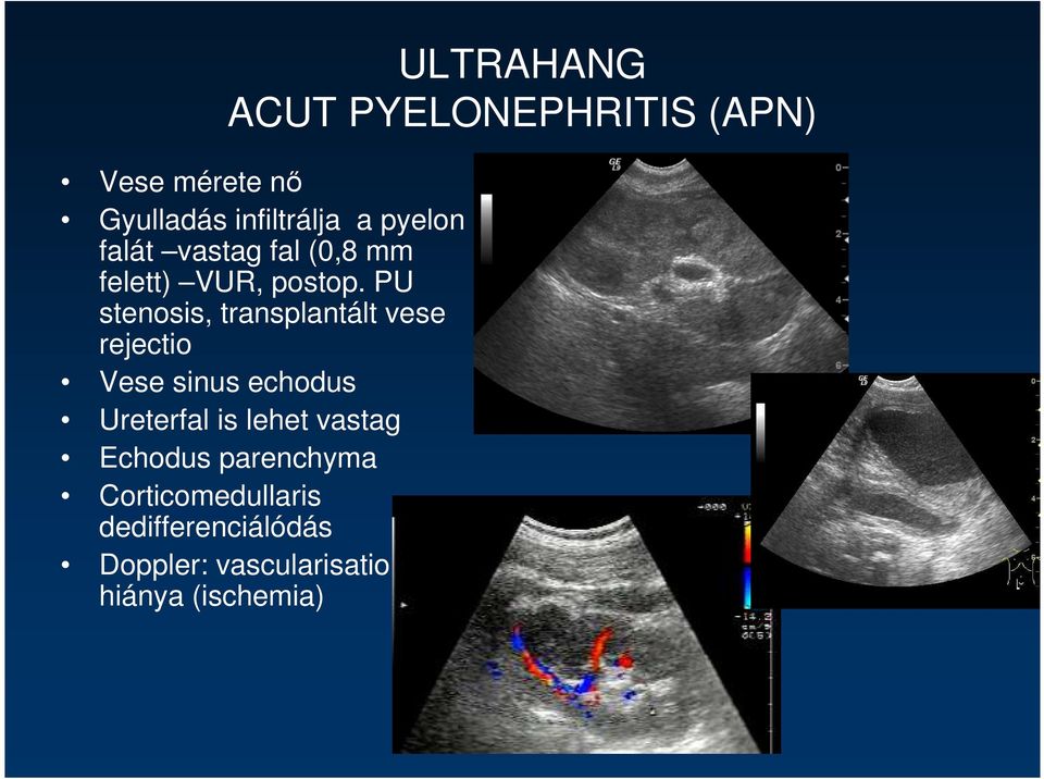 PU stenosis, transplantált vese rejectio Vese sinus echodus Ureterfal is