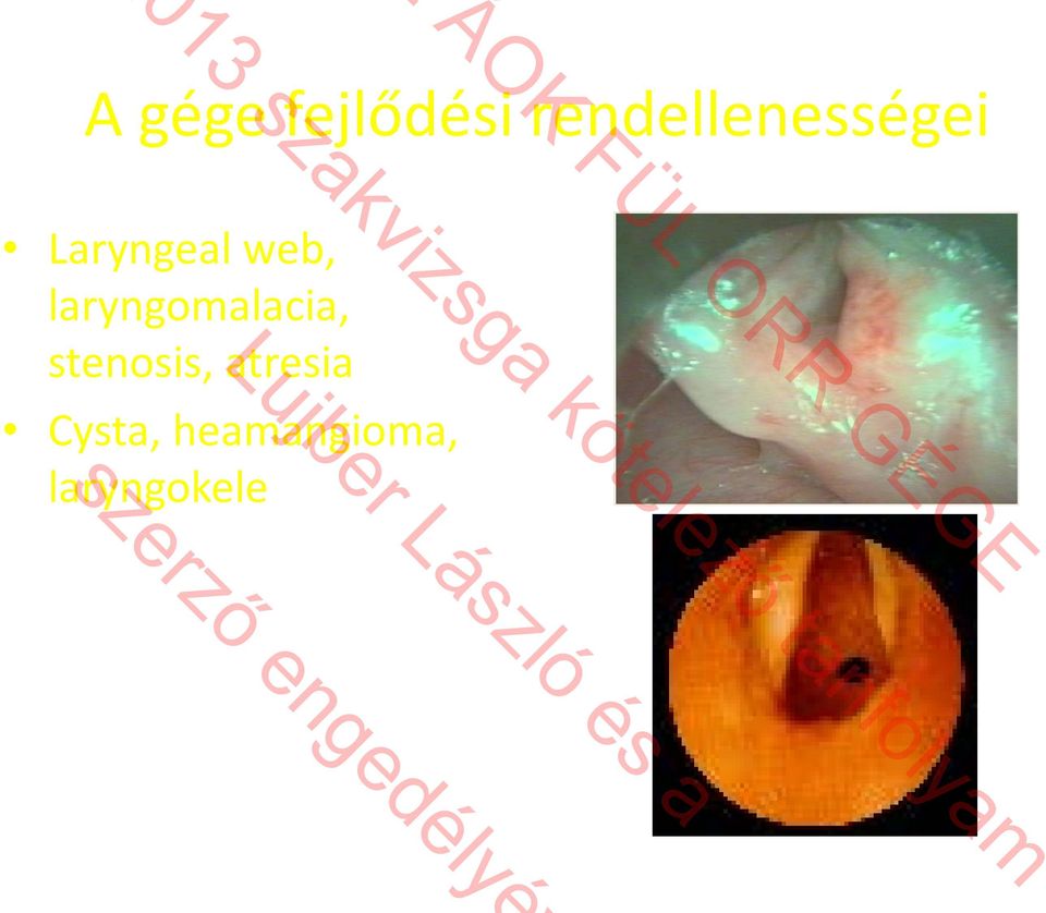 Laryngeal web, laryngomalacia,
