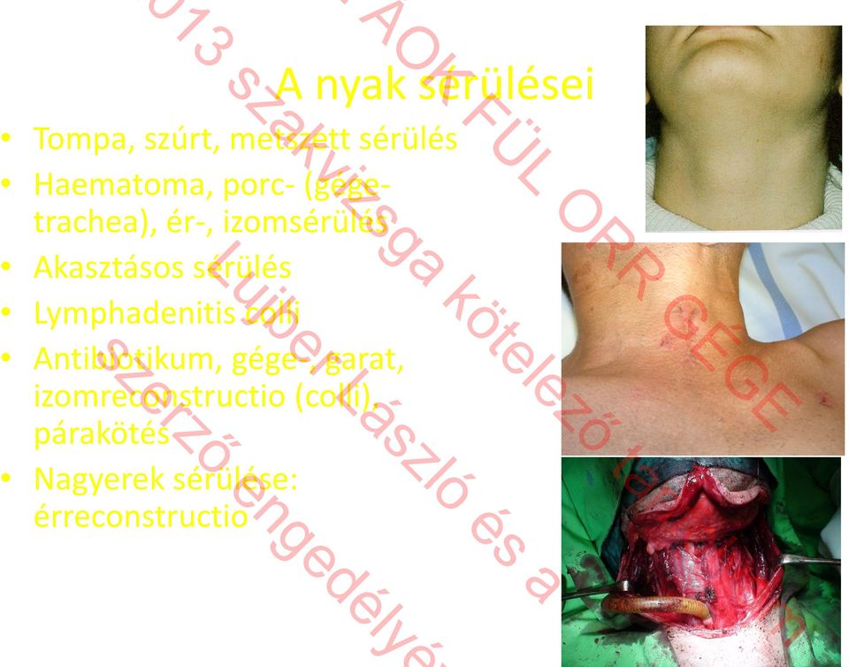 Lymphadenitis colli Antibiotikum, gége-, garat,