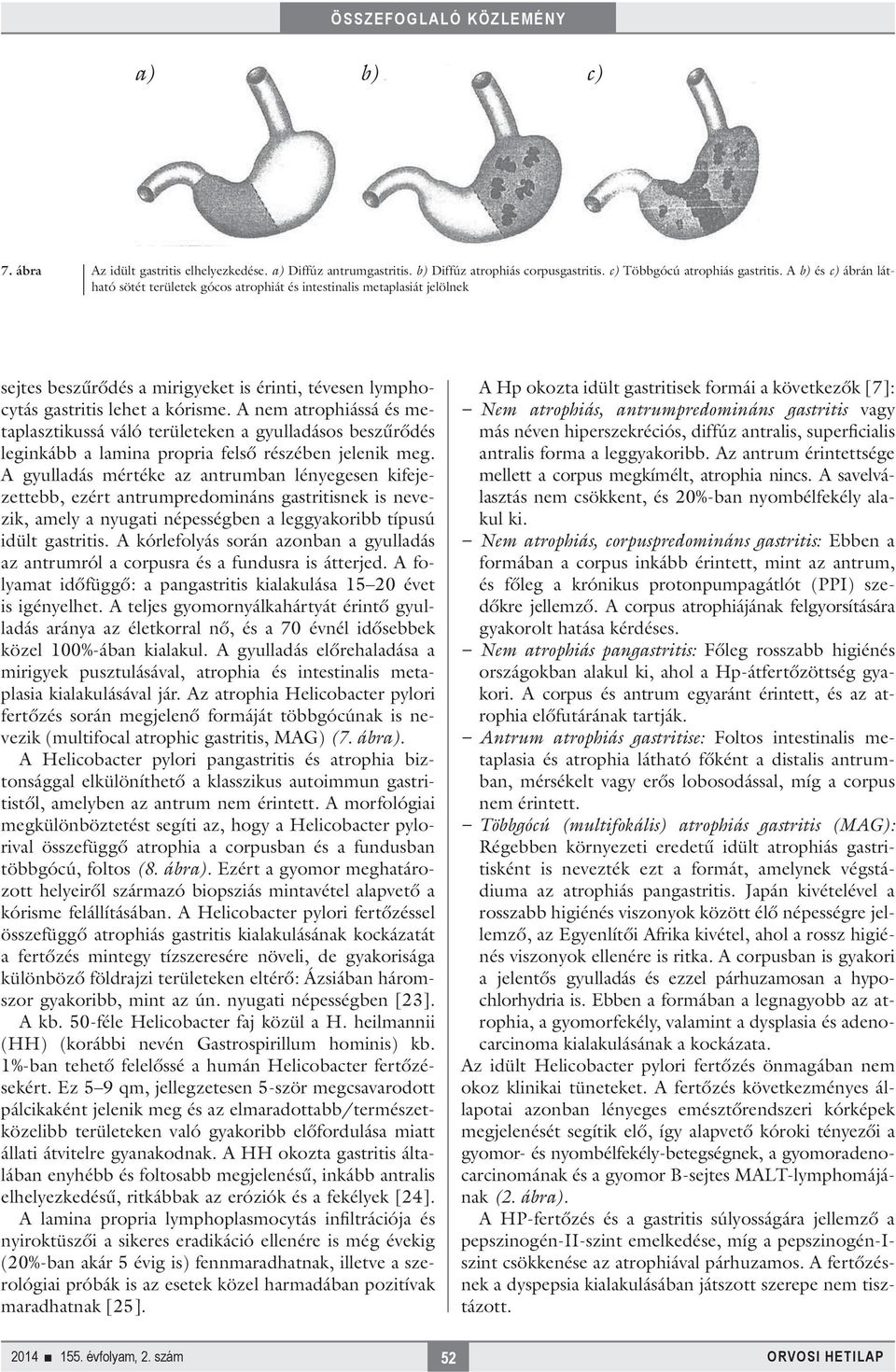 A nem atrophiássá és metaplasztikussá váló területeken a gyulladásos beszűrődés leginkább a lamina propria felső részében jelenik meg.